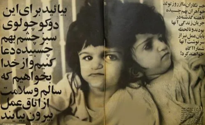 Сиамские близнецов Лалы и Ладан Биджани