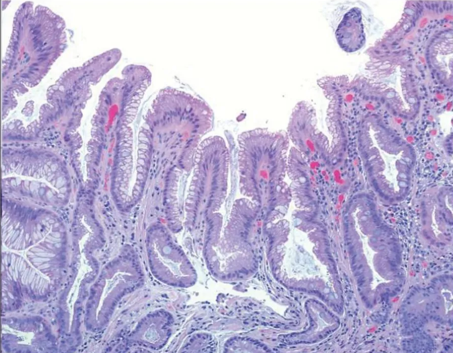 Кишечная метаплазия