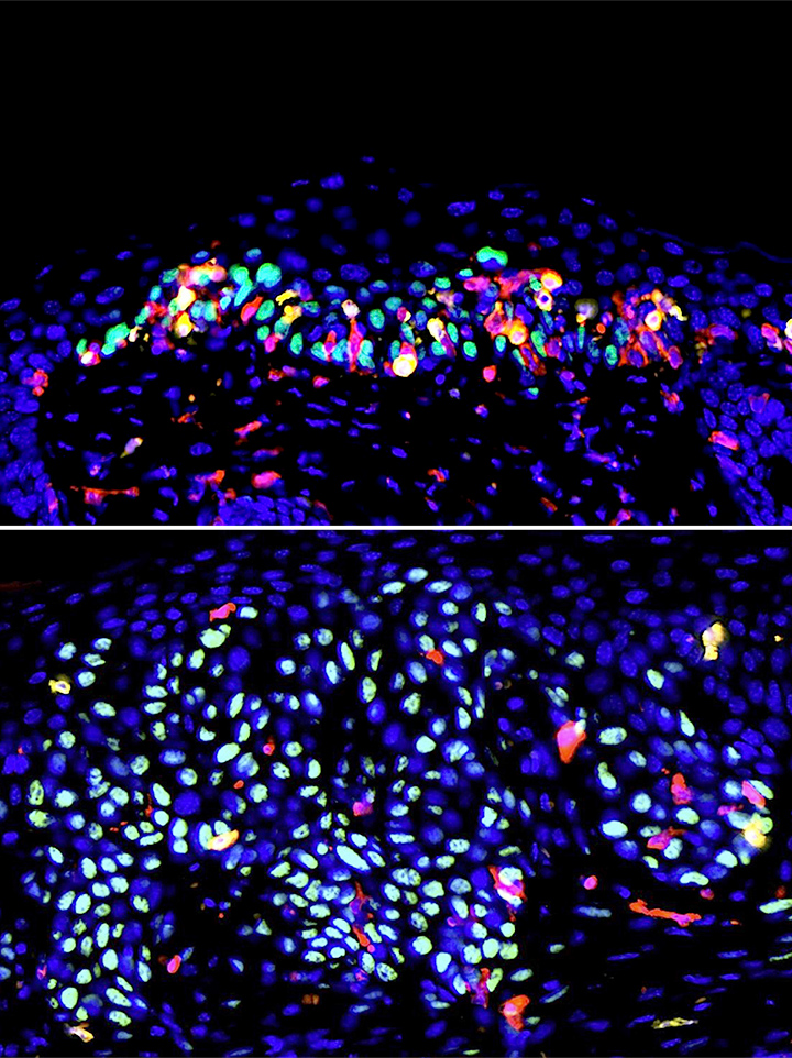 После облучения ультрафиолетом у мышей, зараженных папилломавирусом (вверху), в коже было больше иммунных клеток (желтые и красные) и меньше мутантных клеток (голубые) по сравнению с неинфицированным контролем (внизу). Фото: Heehwa Son/Demehri Laboratory/Massachusetts General Hospital.