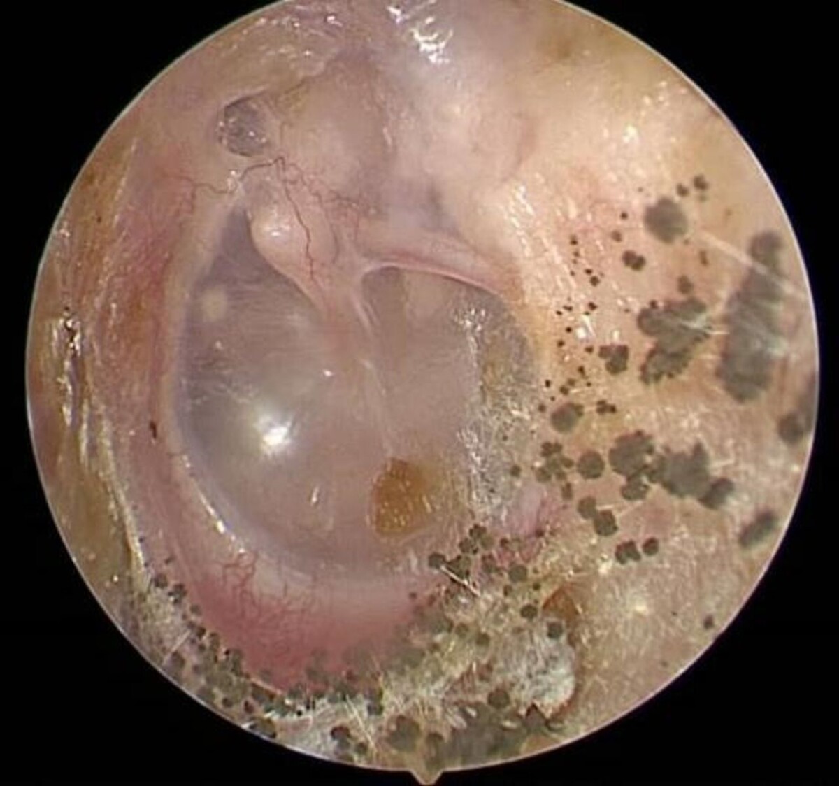 Видны черные грибковые споры Aspergillus niger в слуховом проходе