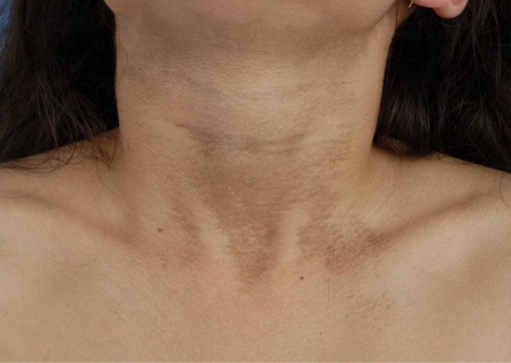 Грязный дерматоз. Фото взято с https://kvd4.ru/gryaznyj-dermatoz-dunkana/?ysclid=m55llurgm2321768499