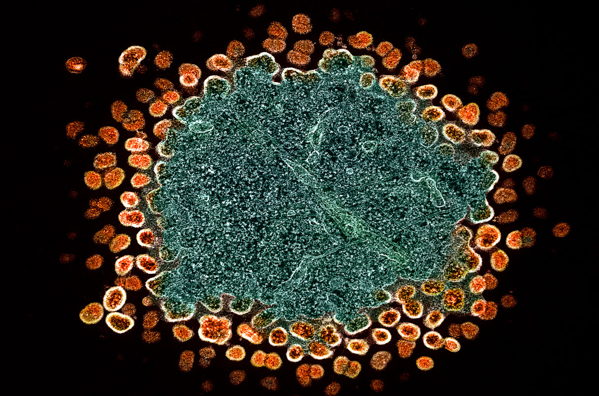 Трансмиссионная электронная микрофотография частиц вируса ВИЧ-1, реплицирующихся в инфицированной Т-клетке. Фото: National Institute of Allergy and Infectious Diseases.