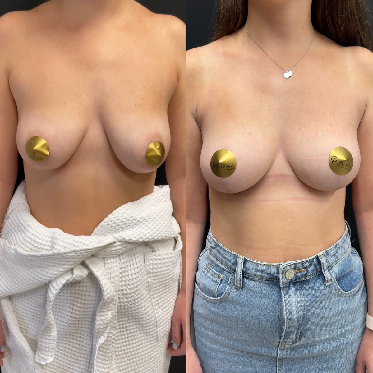 фото подтяжки без имплантов на сроке один год 