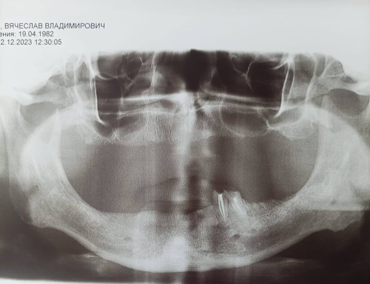 Снимок "до". На нижней челюсти только два зуба (корни). 