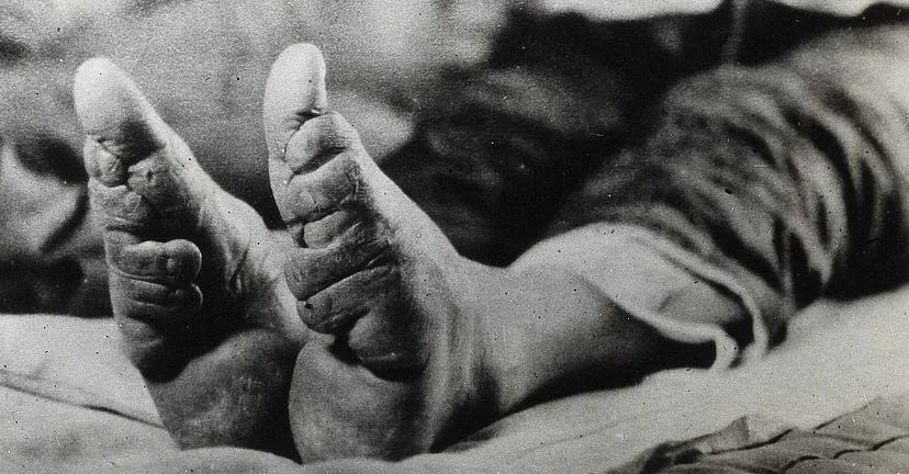 В ранних китайских династиях бинтование ног считалось способом демонстрации богатства для семей знати. Это был болезненный процесс, которому подвергались девочки в возрасте от 4 до 6 лет. В некоторых случаях инфекция распространялась так сильно, что нога начинала гнить.