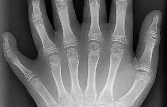 Рентгеновский снимок шестипалой кисти с полностью сформированными пальцами