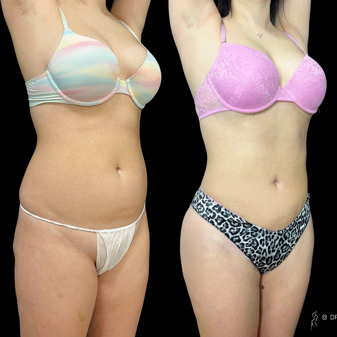 Липоскульптура с липосакцией живота, спины, липофилинг ягодиц