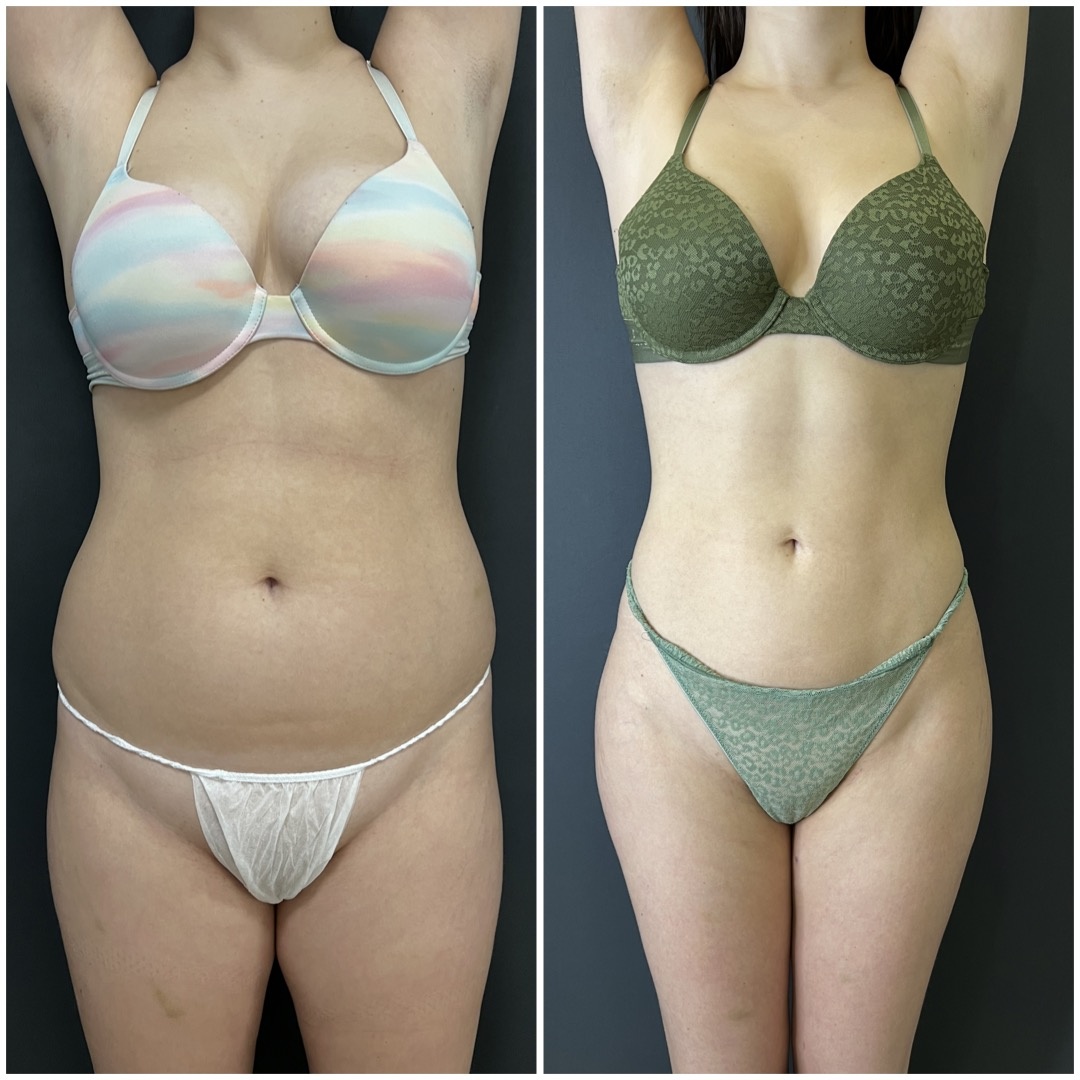 Ультразвуковая липосакция