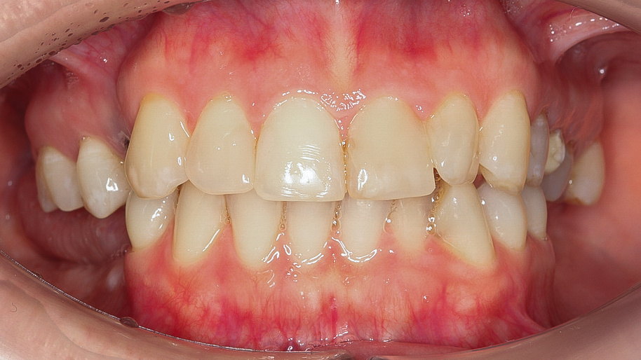 Зубы Виктории ДО 