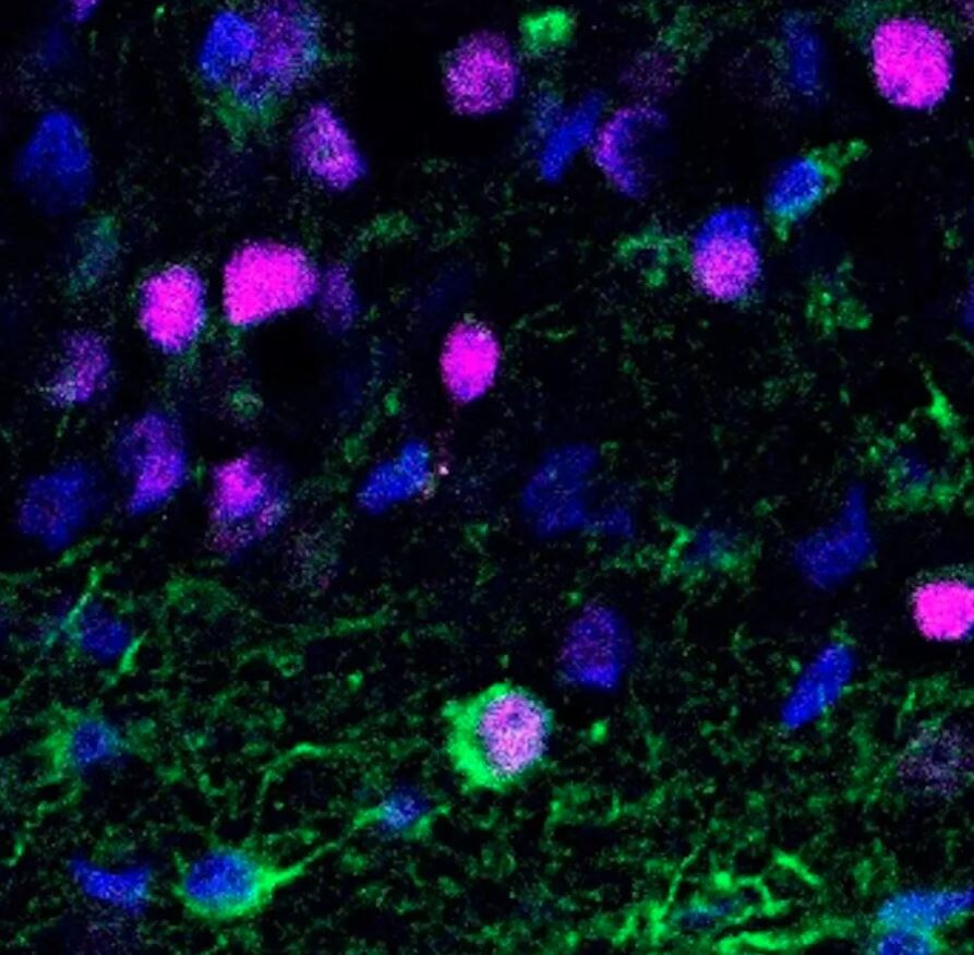 Новорожденные нейроны (зеленые и фиолетовые) в мозговой ткани пациентов с эпилепсией.