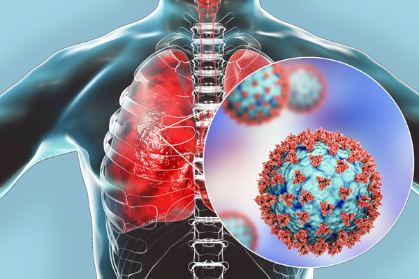 Что такое коронавирусная пневмония?