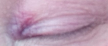 Ну и собственно сам синяк🤣