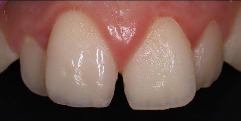 Фото нашего пациента после реставрации зуба.