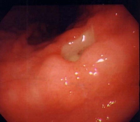 Язва слизистой оболочки желудка видна в виде углубления с желтоватым фибринозным налетом. Снимок сделан фиброскопом.