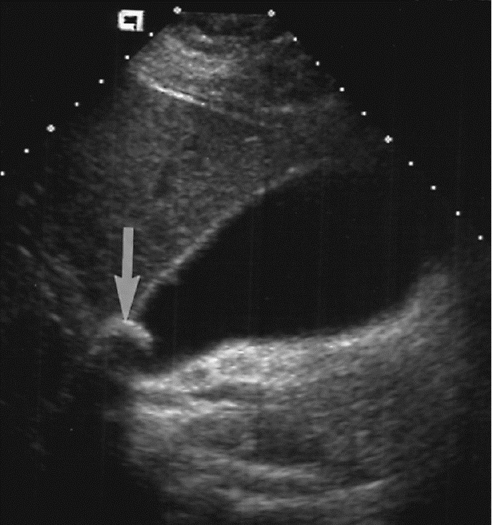 УЗИ желчного пузыря. Стрелкой показан камень желчного пузяря. 