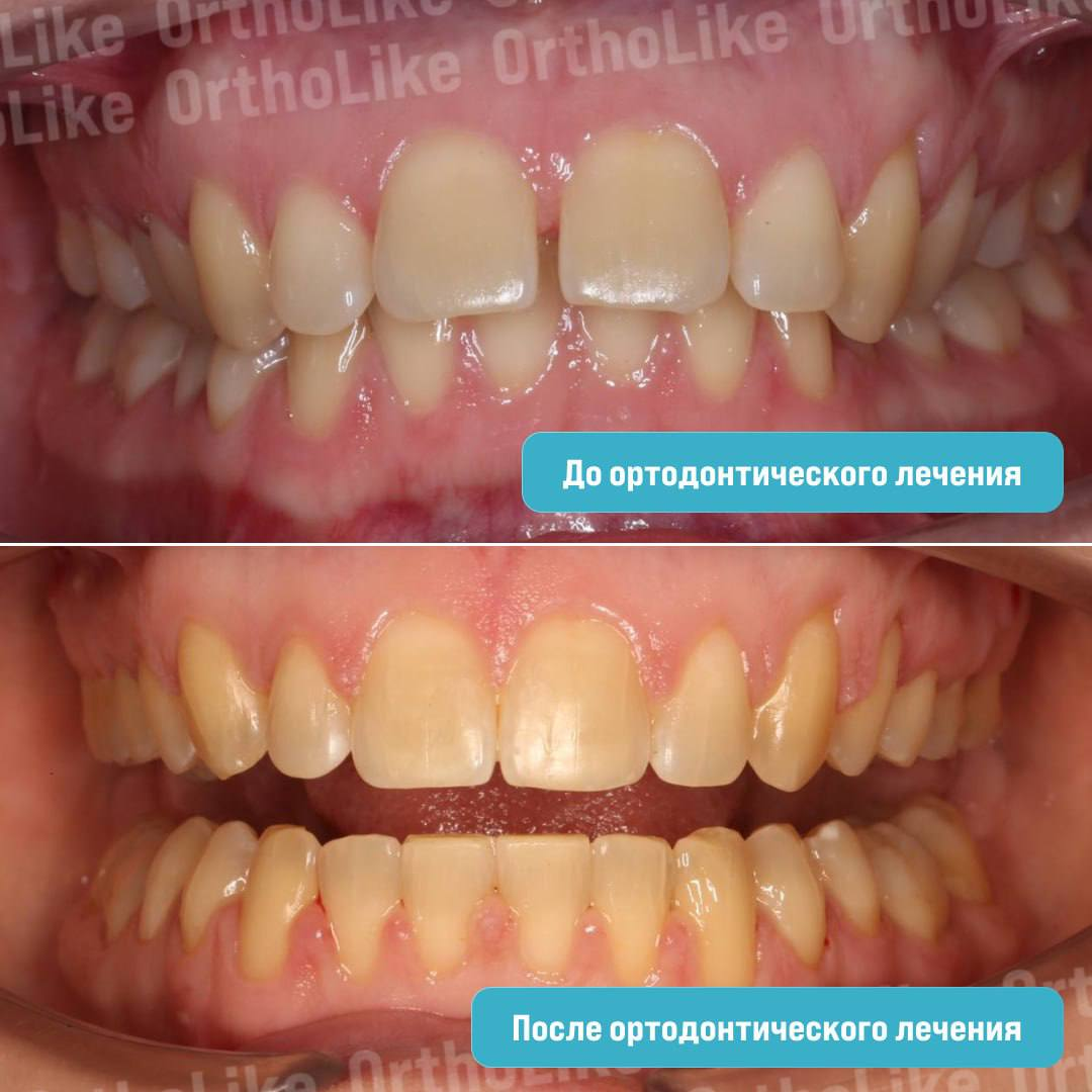 До и после ортодонтического лечения
