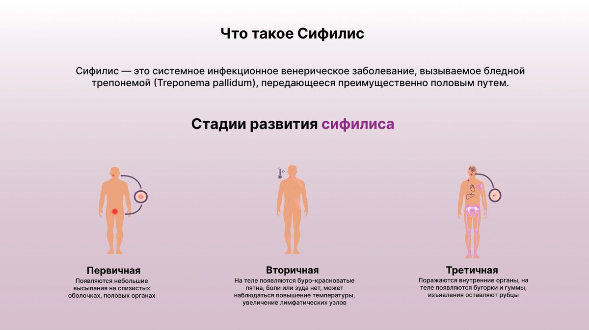    Сифилис: модная болезнь из Америки