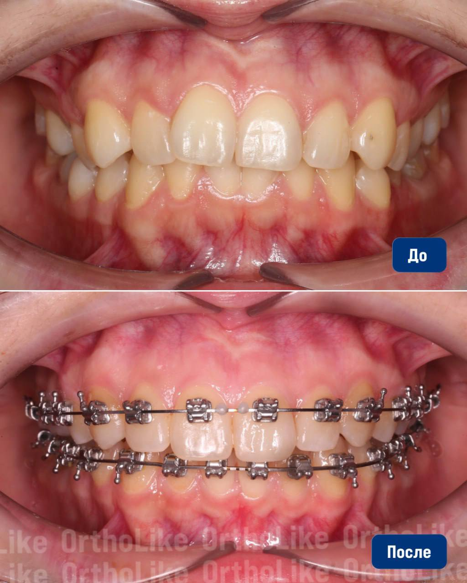 Исправление скученности зубов на брекетах: до и после лечения