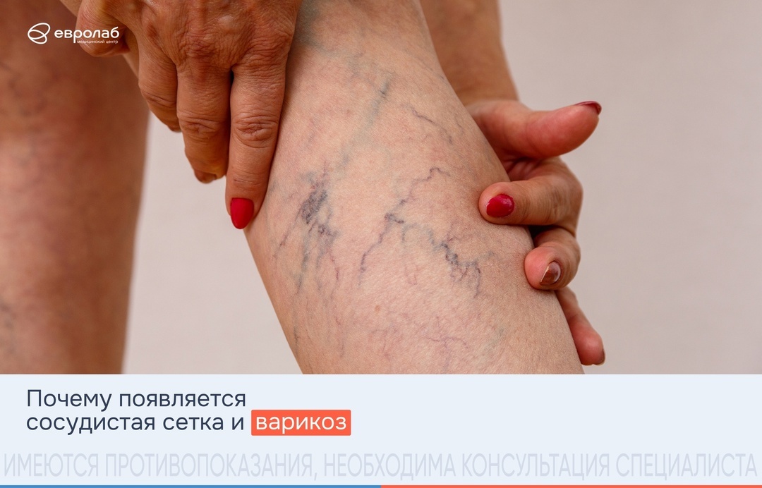 сосудистая сетка: причины