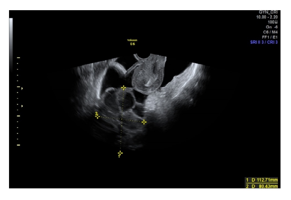 Темная сторона «random-start» стимуляции яичников: синдром ...