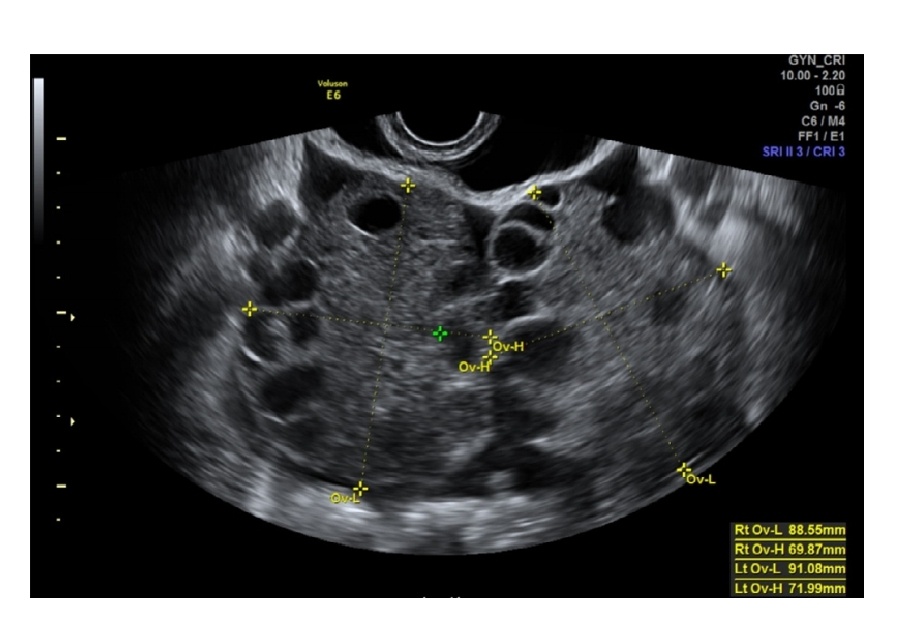 Темная сторона «random-start» стимуляции яичников: синдром ...