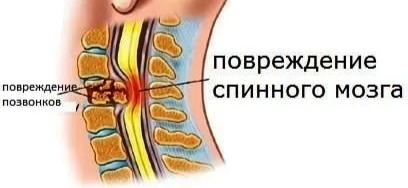 Повреждение позвонков и спинного мозга. Картинка взята из интернета 