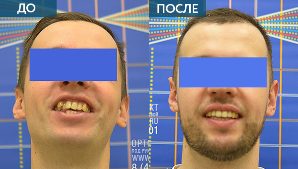 Исправление прикуса у взрослого пациента с помощью alf аппарата и брекетов до и после