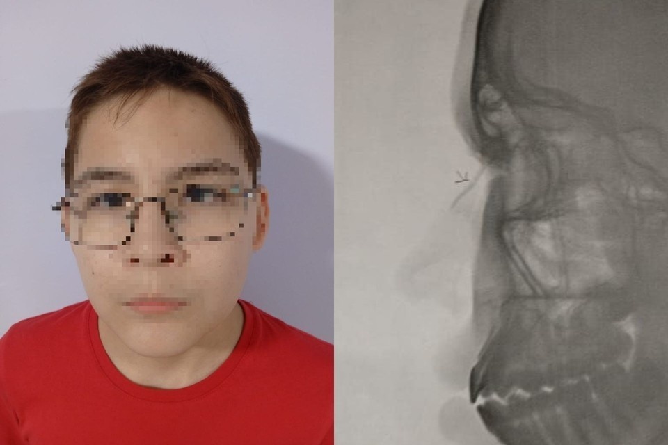    Мальчик с сотрясением и снимок другого школьника - ему хулиганы сломали нос. Предоставлено "Комсомолке"