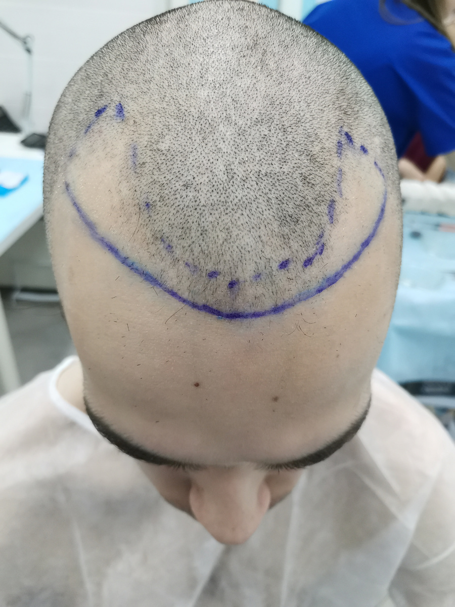 Зона постановки — лоб, виски, формирование первой линии роста волос