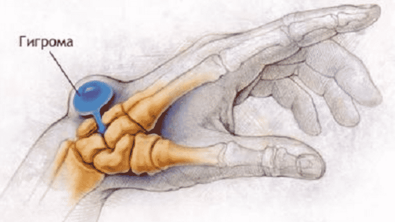 Вот такая штука. Только у дочки в другом месте на руке. но смысл тот же. Исчтоник картинки тут: revmatolog.org