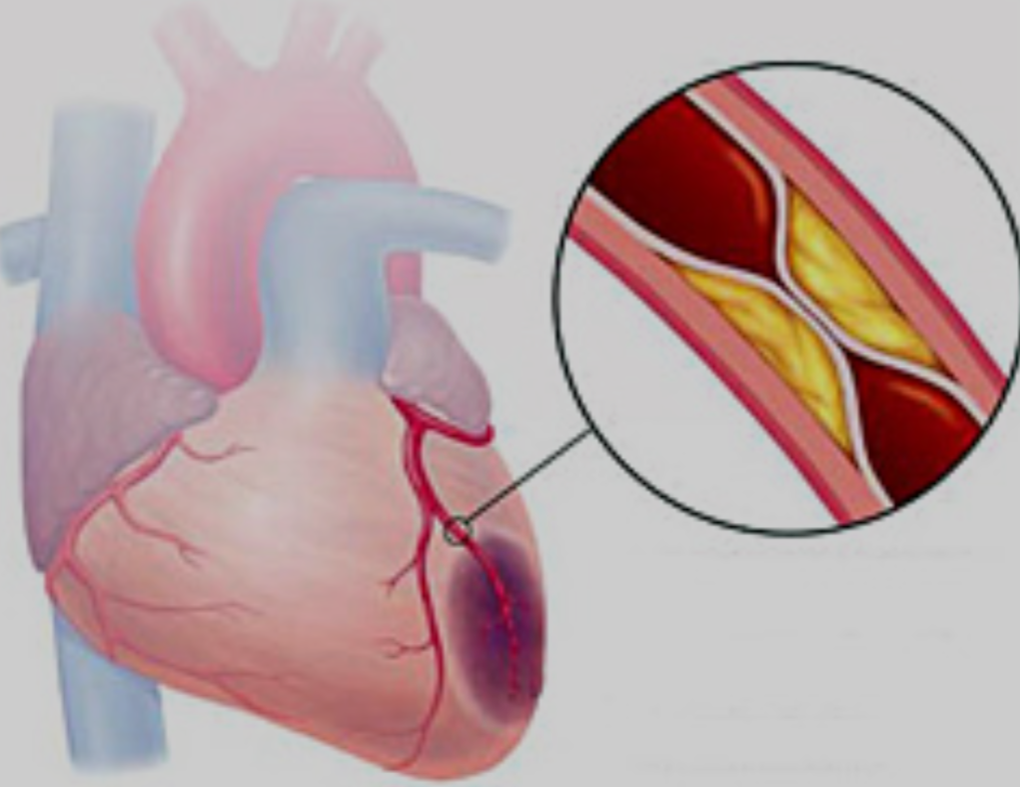 Атеросклеротическая бляшка в сосуде сердца