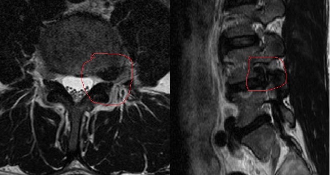 Масштабная экструзия диска L4-5 в область левого фораминарного отверстия с краниальной миграцией секвестра. Снимок сделан в пределах месяца после появления болевых ощущений и легкого неврологического дефицита.