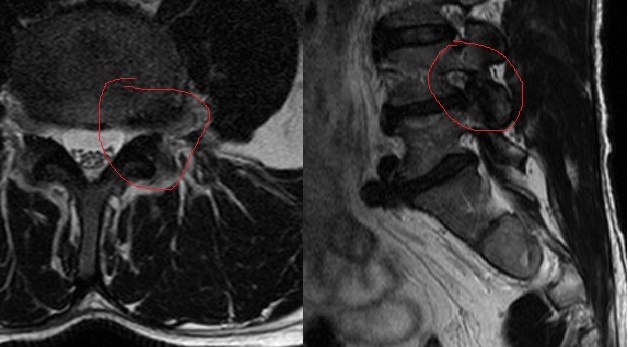 Тот же пациент, отснятый примерно через полгода. На саггитальном срезе хорошо видно, как освободилось фораминарное отверстие. 