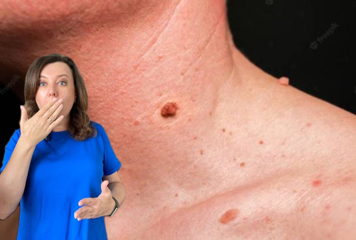 папилломы / коллаж Другой Кухни