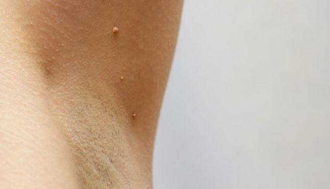 папилломы фото из интренета