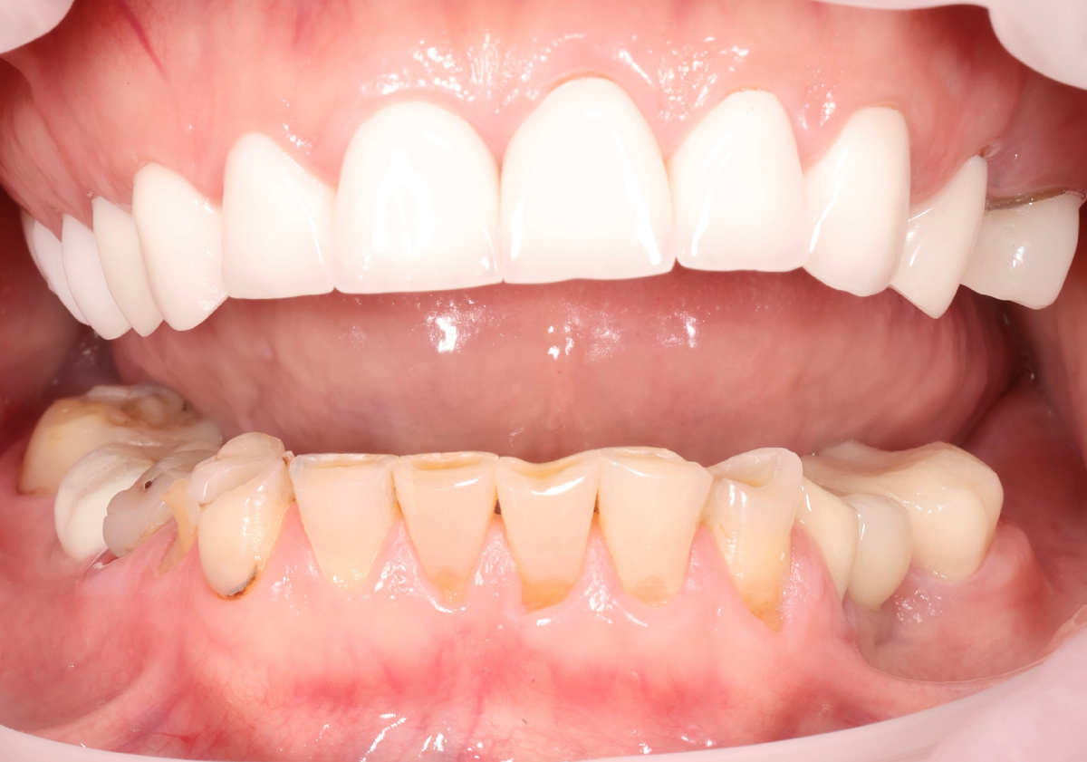 Верх - циркониевые коронки, низ - своё