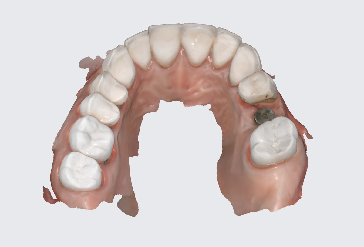 Коронки (не виниры) - зубы полностью покрыты реставрациями (нёбно, в том числе)