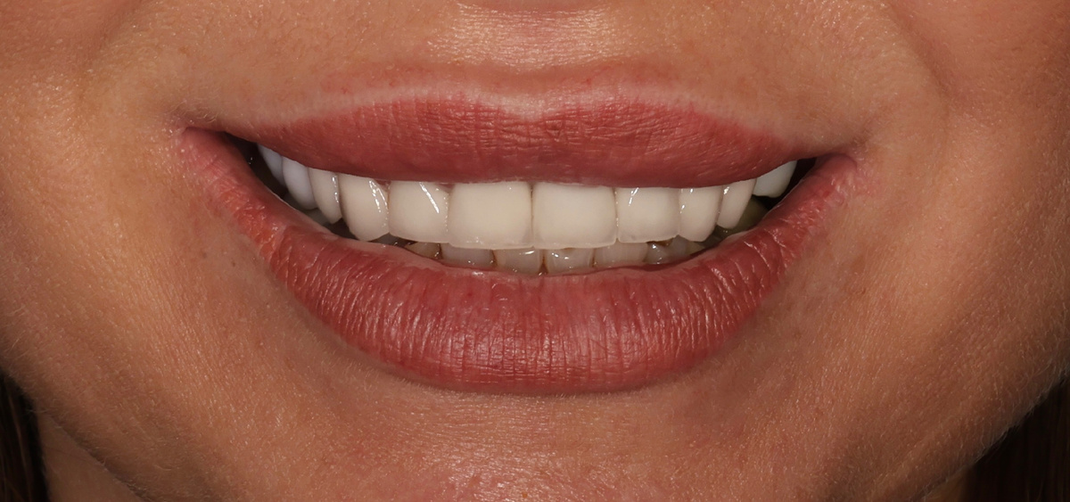 Улыбка до. Зубы нижней челюсти картину не портят