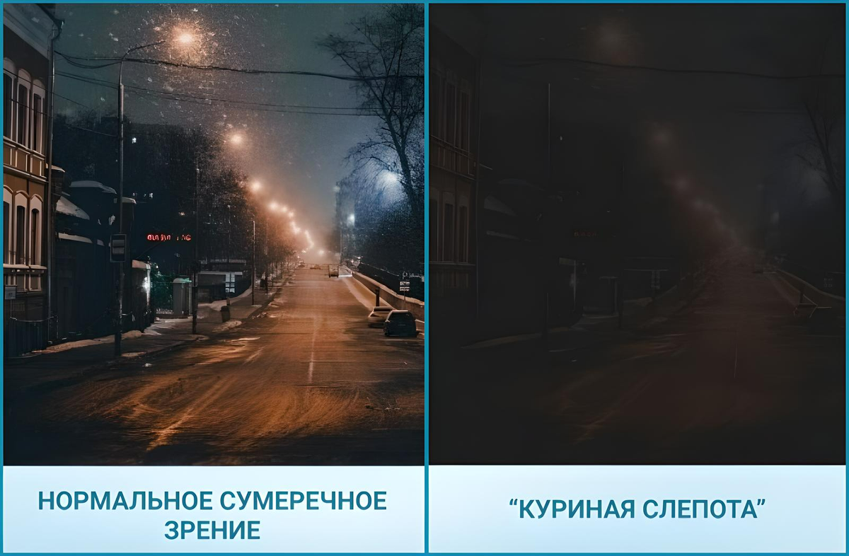 Одним из самых основных симптомов является "куриная слепота" — когда человек прекрасно видит при хорошем освещении, а в сумерках острота зрения снижается и появляется расплывчатость.