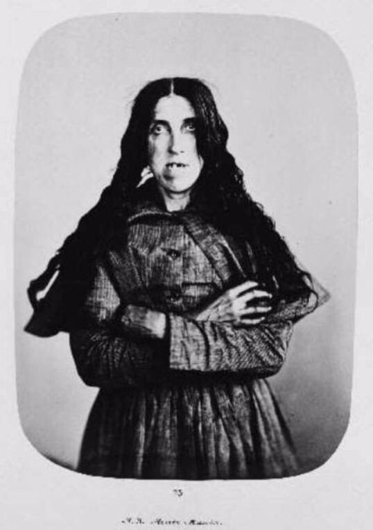 Пациентка Бетлемской Королевской Больницы Лондона (Бедлама) с маниакальным синдромом в середине XIX века.