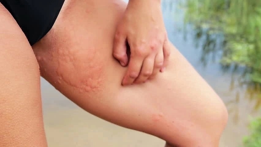 Микоз влагалища. Источник: https://vk.com/wall-23967044_3780554