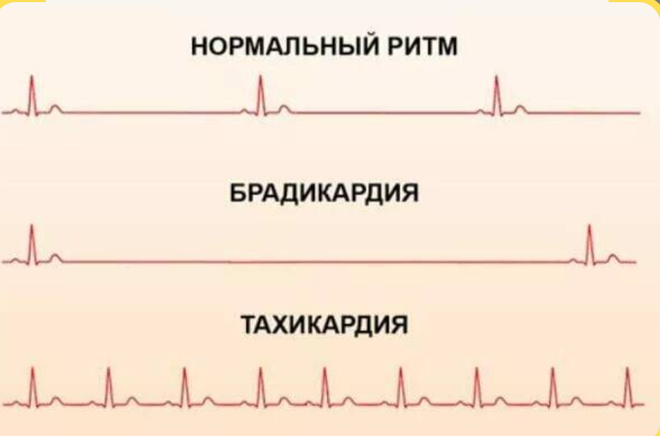 Пример кардиограммы (ЭКГ).