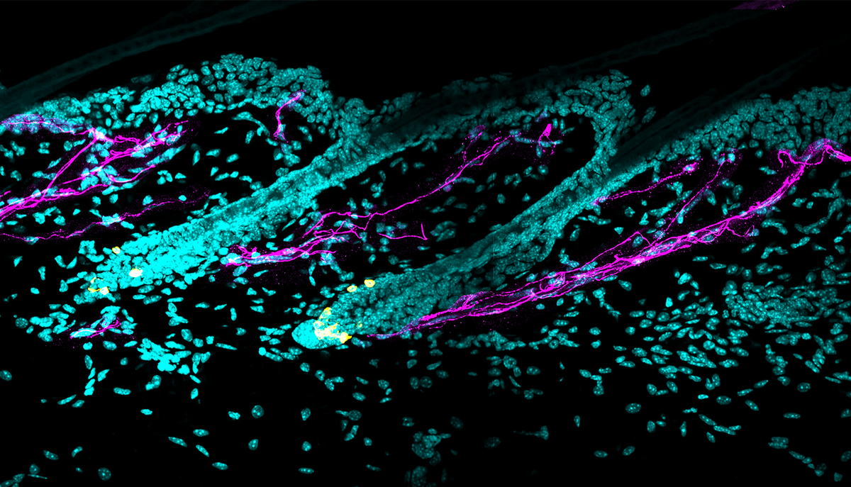 Сложная симпатическая иннервация (окрашено пурпурным) вокруг восстанавливающих пигмент стволовых клеток (окрашены жёлтым). Острый стресс вызывает гиперактивацию симпатической нервной системы для высвобождения большого количества нейромедиатора норадреналина. Норадреналин приводит к быстрому истощению регенерирующих пигмент стволовых клеток и поседению волос.
