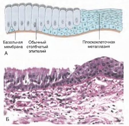 Плоскоклеточная метаплазия респираторного эпителия в бронхах и трахее у курильщиков 