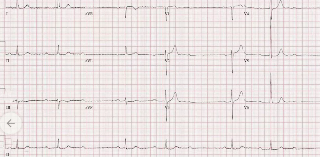 Вот так выглядит предсердно-желудочковая блокада 2 степени 1 типа, только тут целых три эпизода и по ряду причин ситуация тут явно хуже, чем та, что описана мною