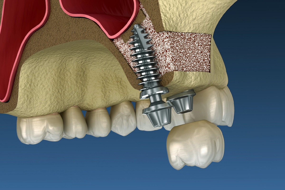 Синус лифтинг 