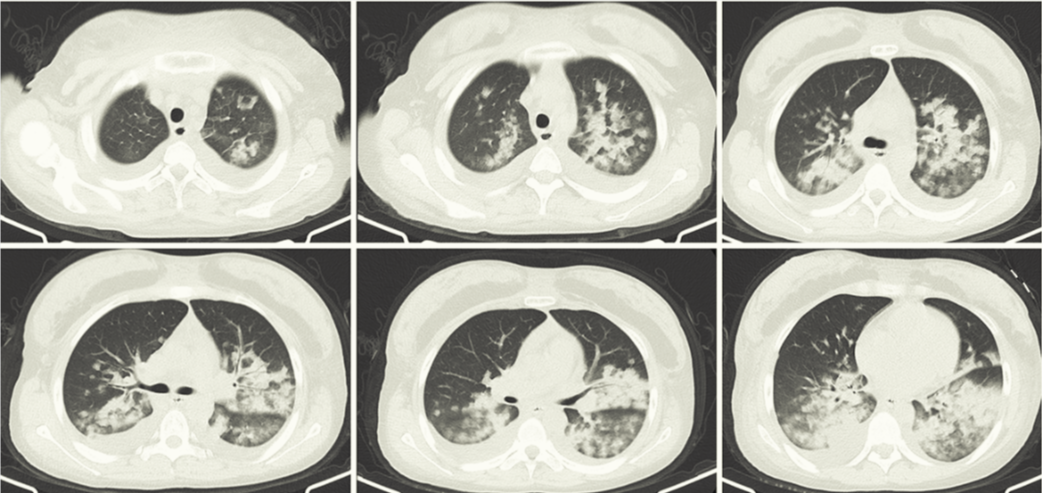 На серии аксиальных срезов МСКТ органов грудной полости в нативную фазу исследования определяется двустороннее снижение пневматизации легочной паренхимы в виде уплотнения по типу консолидации, а также очагов в виде "матового стекла" (морфологически соответствуют альвеолярному отеку легких), двусторонний плевральный выпот