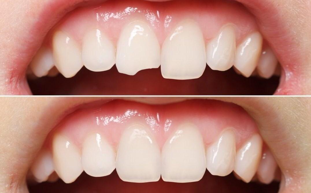 Прямая композитная реставрация передних зубов