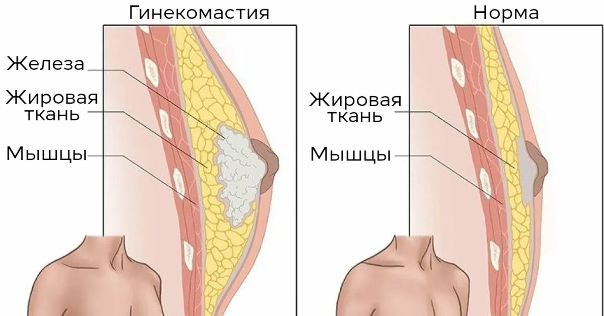 Женская грудь у мужчин (гинекомастия). Источник: https://diagnost-nsk.ru/39773-2/