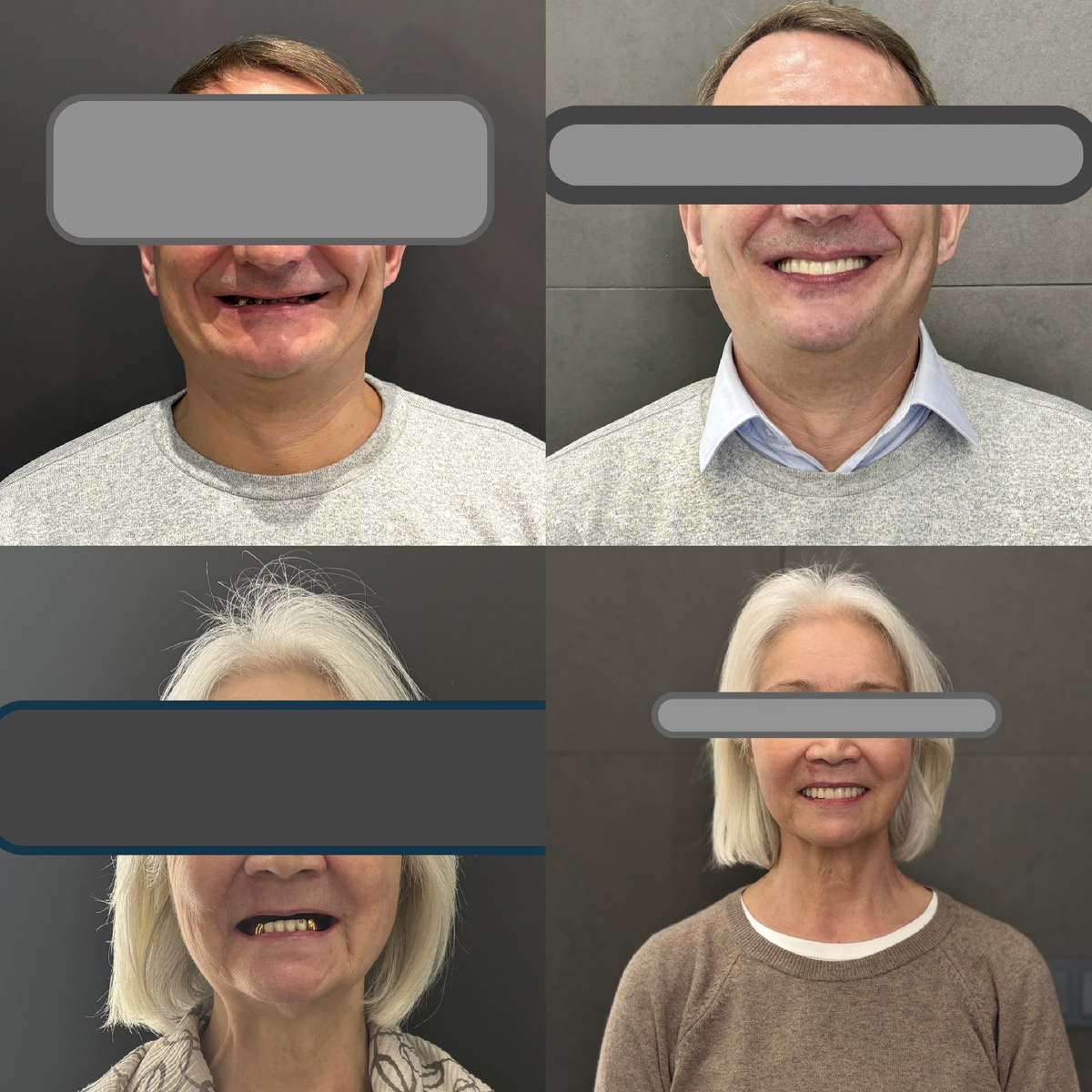 Наши тотальные работы на имплантатах